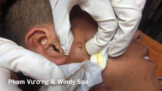 (59) CYST IN THE CHEEK | Windy Spa