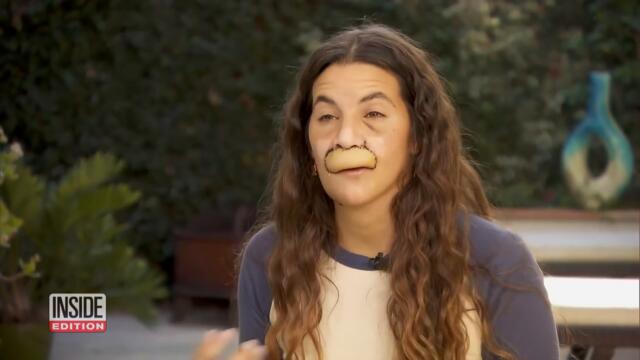 22-Year-Old Model Got Her Lip Ripped Off by a Pit Bull