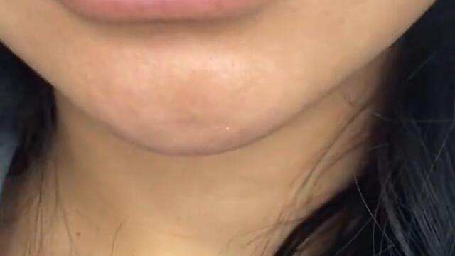 Lip fillers near me Los Angeles California