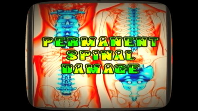 PSD (Permanent Spinal Damage) - Remix