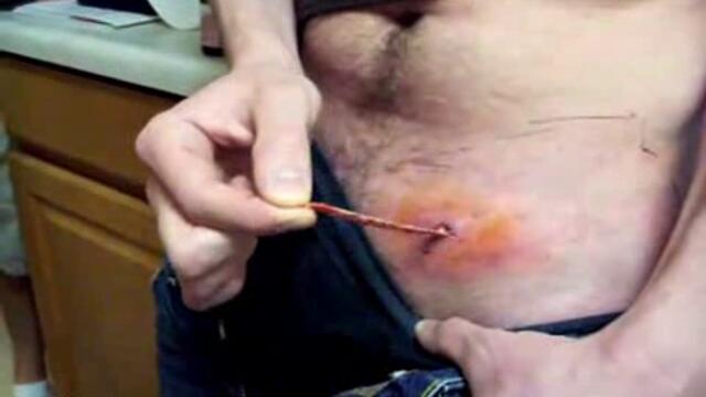 Издърпване на червей от корема - Vbox7[via torchbrowser.com]