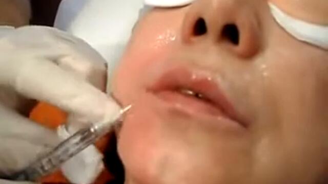 Запълване на бръчките над устните-240p