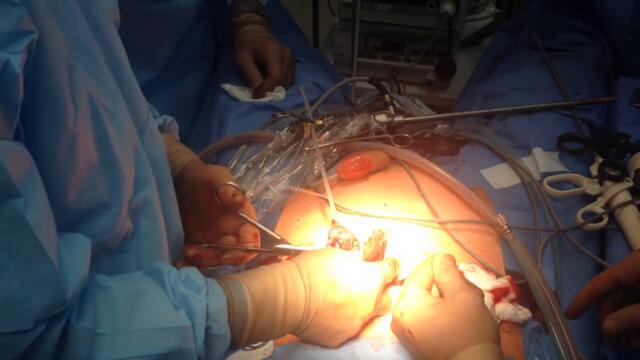 Уникален момент - изваждане на простатен карцином при лапароскопия-720p