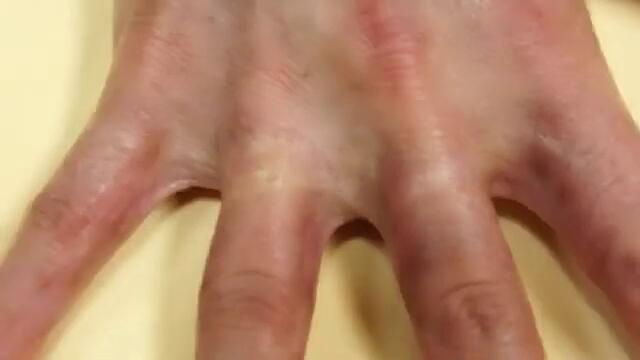 fraxel_patient (360p)