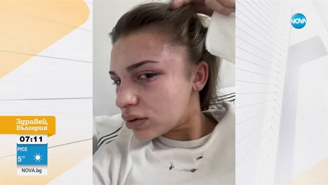 „Казваше, че ще умра в този момент“: Млада жена беше жестоко пребита от бившия ѝ приятел