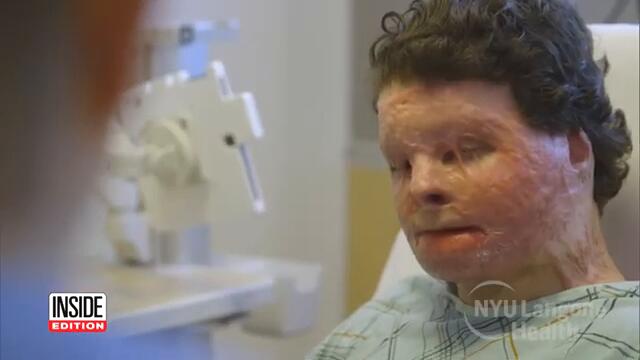 Man Who Had Face and Double-Hand Transplant Gets Married